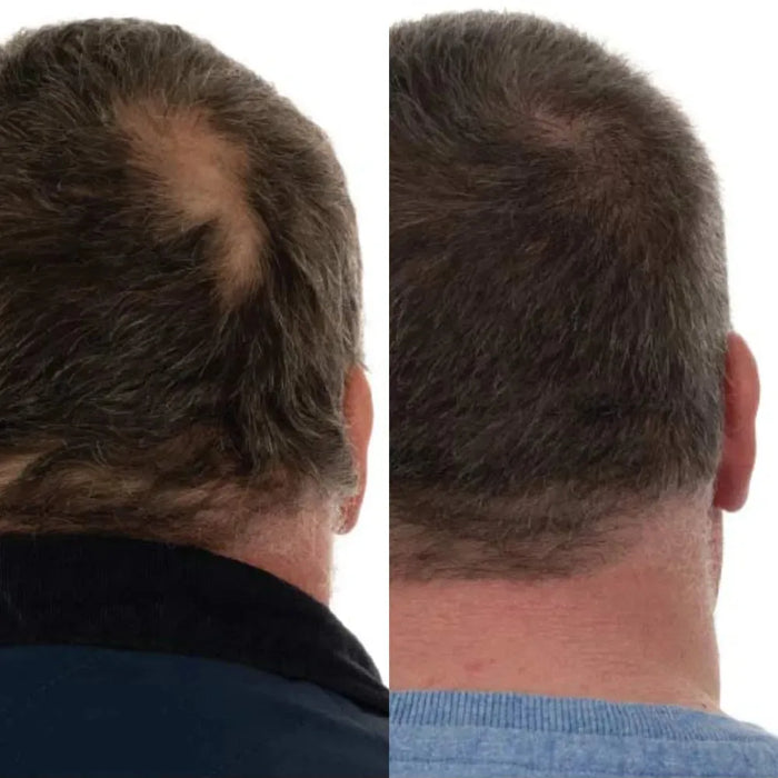Foligain hair growth treatment (men) - Hairgivers