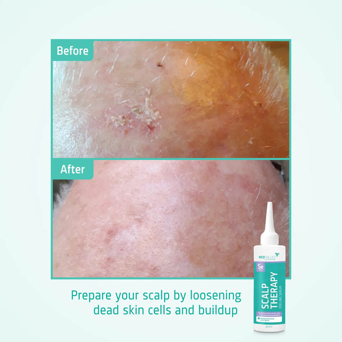 Neofollics scalp peeling serum